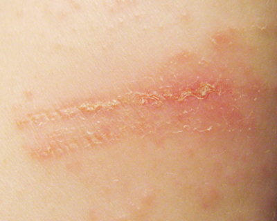 Contact dermatitis on skin (c) UC Regents. All rights reserved.