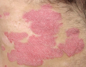 A psoriasis plaque on the skin (c) UC Regents. All rights reserved.