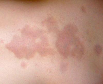 Scleroderma on the skin (c) UC Regents. All rights reserved.