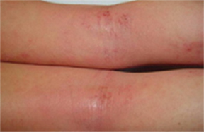 Eczema on a person's skin (c) UC Regents. All rights reserved.