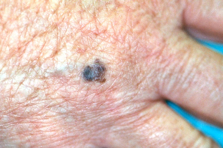 Melanoma on a hand (c) UC Regents. All rights reserved.