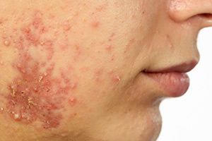 Face with acne blemishes (c) UC Regents. All rights reserved.