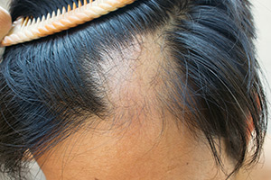 Hair loss on a person's scalp. (c) UC Regents. All rights reserved.