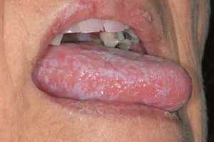Oral mucosal disease on a tongue (c) UC Regents. All rights reserved.