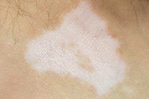 Vitiligo on a person's skin (c) UC Regents. All rights reserved.