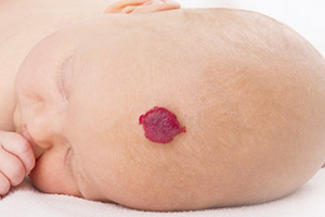Baby with skin condition on forehead (c) UC Regents. All rights reserved.