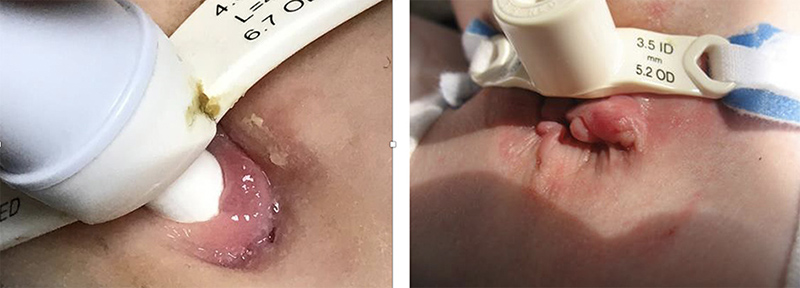 granuloma