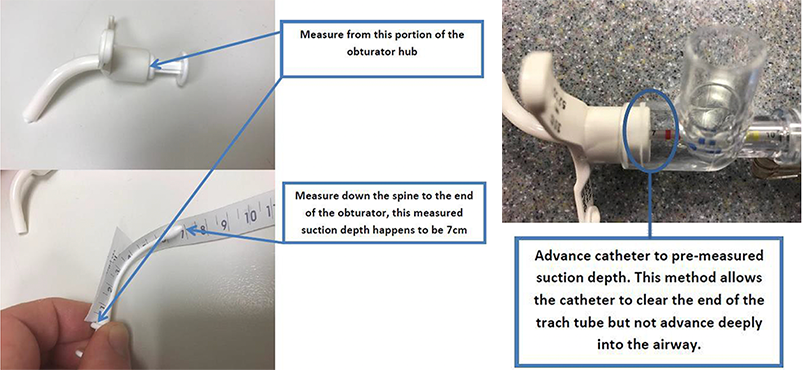 How to pre-measure suction depth  How to pre-measure Advance catheter suction depth