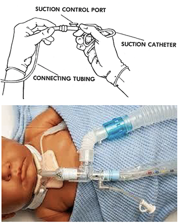 steps for suctioning