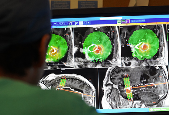Surgeons performing brain tumor surgery in operating room.