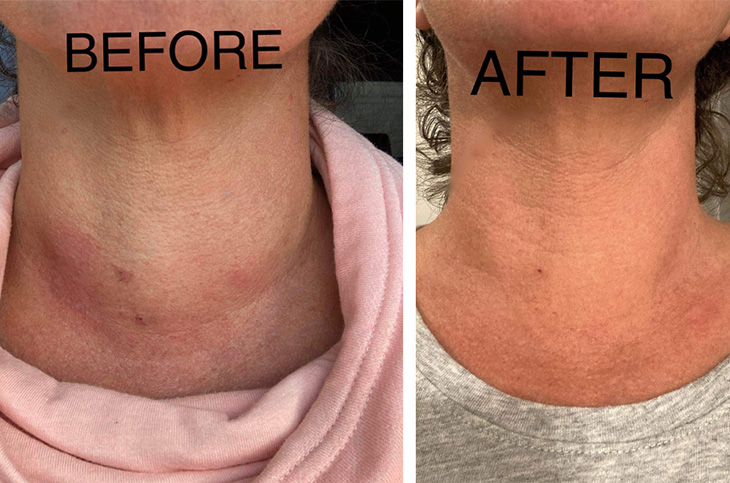 Before-and-after photos showing reduced swelling in the neck after thyroid nodule treatment.