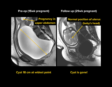 Three MRI images of a woman’s pregnant abdomen