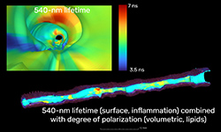 A screenshot from an animation that depicts false-color ivCSM images of a human coronary artery.