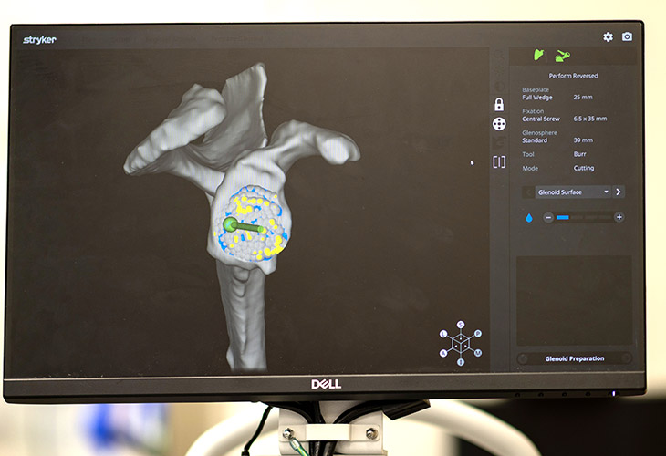 A robotic assisted surgery navigation monitor during a surgery