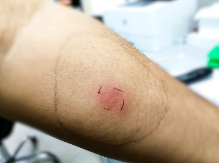 Close-up photo of patient’s arm with ink marks next to a raised red spot on the skin and a larger, circled ink mark.