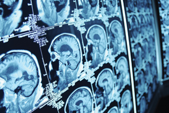 Brain MRI scans displayed on a lightboard in a clinical setting.