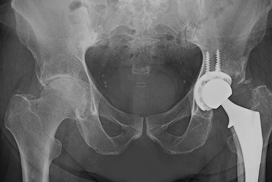 Hip xray image showing hip replacement.