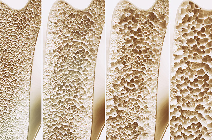 A graphic simulating bone loss.