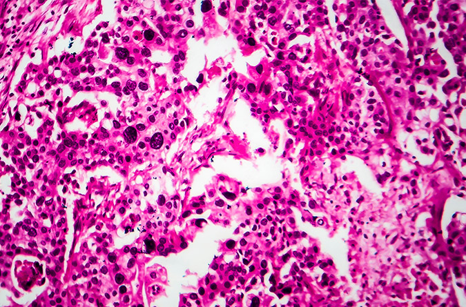Cancer cells from under a microscope.