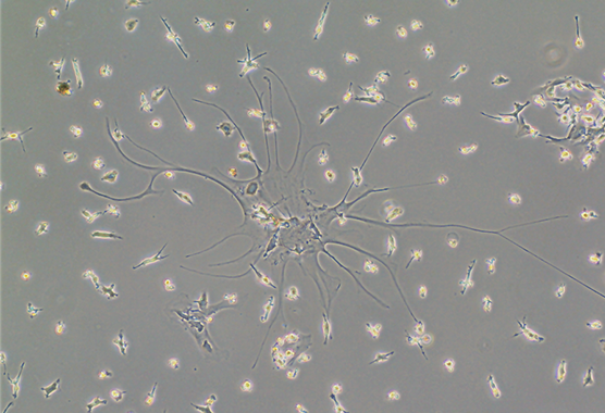 brain tumor cells