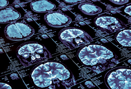 Brain tumor mri
