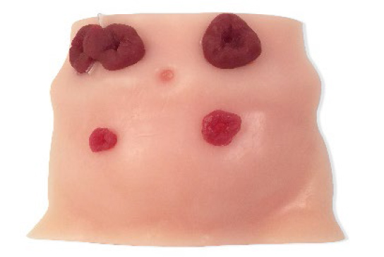 Ostomy Care Model