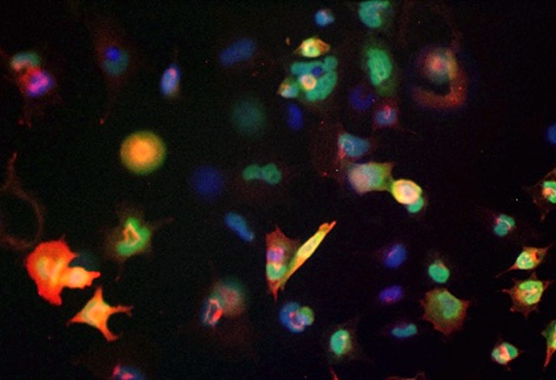 Liu Lab-Understanding therapy resistance and disease progression in advanced prostate cancer